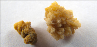 Illustration for article titled What Is Causing the Kidney Stone Epidemic?